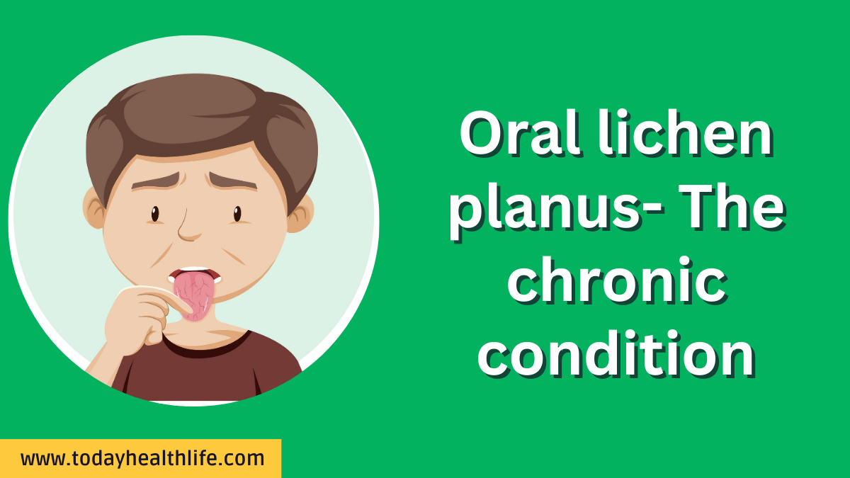 Oral lichen planus- The chronic condition