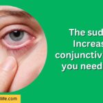 The sudden Increased conjunctivitis - all you need to do